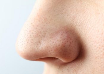 Cara Menghilangkan Komedo di Hidung Secara Alami