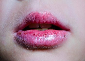 Bibir Pecah-pecah